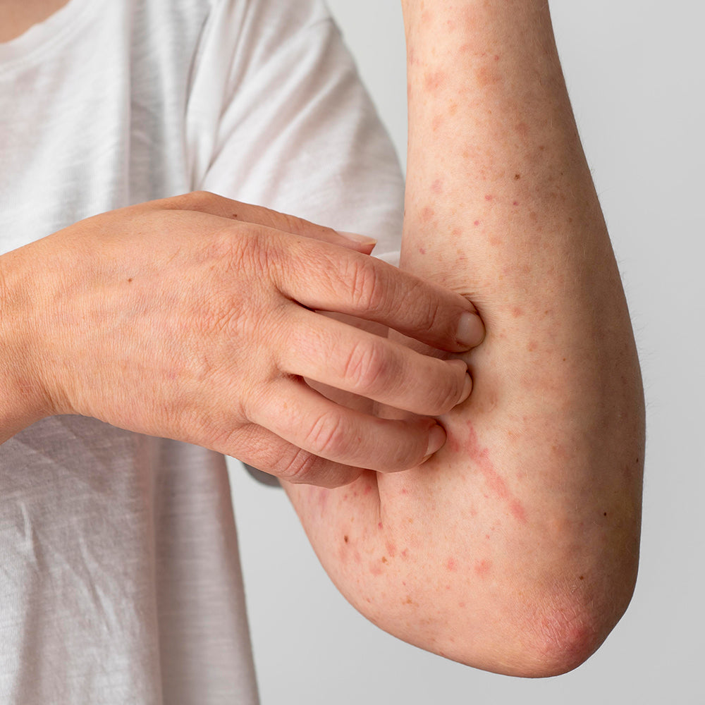 Psoriasis Safety