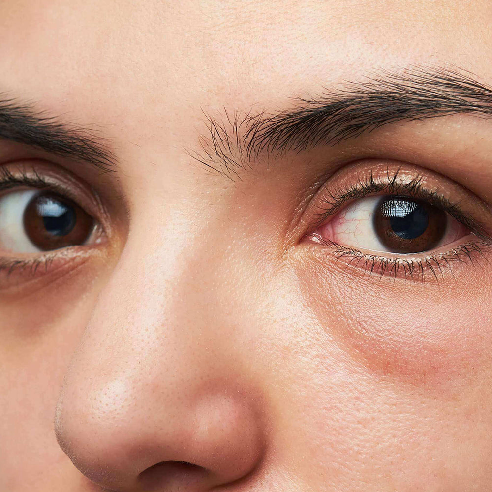 Under-Eye Bag Evaluation