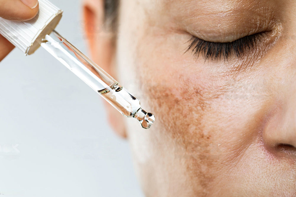 Hyperpigmentation