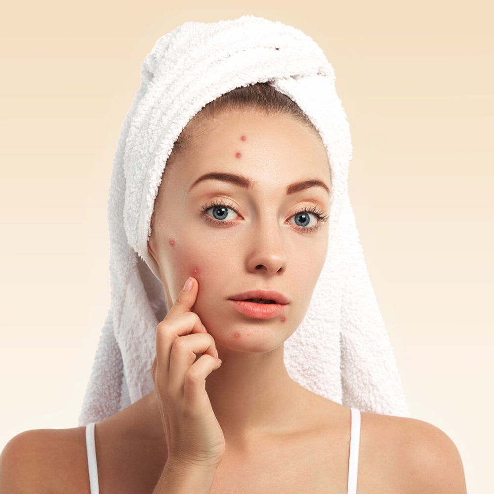 Acne Evaluation